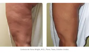 Comparación de radiofrecuencia corporal antes y después: pierna con celulitis visible antes, y pierna con piel más lisa y firme después.