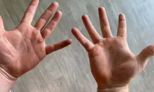 Manos con callos visibles, evidencia de trabajo duro o entrenamiento.