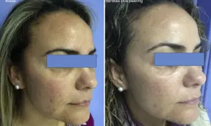 Comparación antes y después de un peeling para manchas. La piel luce más uniforme y luminosa tras el tratamiento.