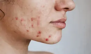 Primer plano de una mejilla con acné inflamado, mostrando la búsqueda de cómo quitar el acné.