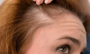 Primer plano de una mujer examinando su cuero cabelludo, preocupada por la caida de pelo.