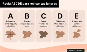 Regla ABCDE para revisar lunares: Asimetría, Bordes irregulares, Color cambiante, Diámetro mayor a 6mm, Evolución rápida. Una mancha negra en la piel puede ser señal de alerta.