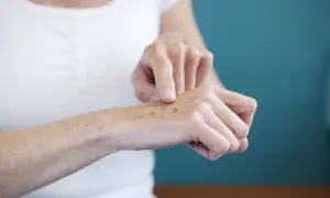 Una persona se señala las manchas en las manos, mostrando la piel con pecas y marcas de sol.