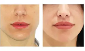 Antes y después de un lip lift: los labios se ven más definidos y voluminosos, logrando un aspecto más juvenil.
