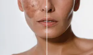 Comparación de piel antes y después de tratamientos despigmentantes, mostrando una reducción visible de manchas y un tono más uniforme.