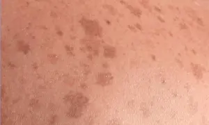 Piel con manchas marrones irregulares, indicativas de lentigo solar, resultado de la exposición al sol.