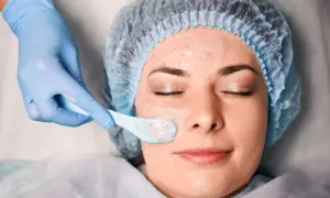 Una mano enguantada aplica una mascarilla en el rostro de una mujer, parte de un tratamiento de peeling químico para renovar la piel.