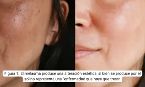 Comparativa de piel con melasma y piel tratada. Buscando amchafibrin para manchas opiniones, se observa mejora.