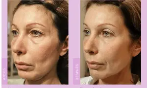 Comparativa de radiofrecuencia facial antes y después. La piel luce más firme y tersa, con menos arrugas y líneas de expresión.
