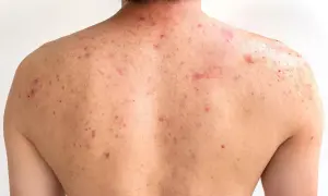 Espalda con numerosos granos y marcas de acné, mostrando rojeces e inflamación.