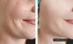 Antes y después de un tratamiento para suavizar las líneas de marioneta y rejuvenecer la piel.