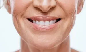 Sonrisa radiante con surco nasogeniano antes y después. Piel tersa y rejuvenecida.