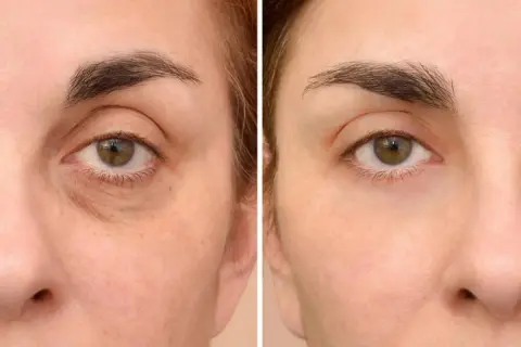 Comparación de ojos: antes con ojeras oscuras y bolsas, después con piel más lisa y luminosa.
