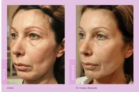 Comparativa de radiofrecuencia facial antes y después. La piel luce más firme y tersa, con menos arrugas y líneas de expresión.