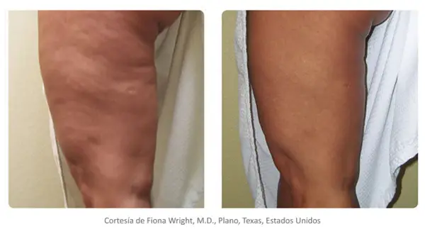Comparación de radiofrecuencia corporal antes y después: pierna con celulitis visible antes, y pierna con piel más lisa y firme después.