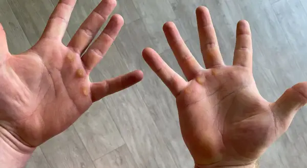 Manos con callos visibles, evidencia de trabajo duro o entrenamiento.