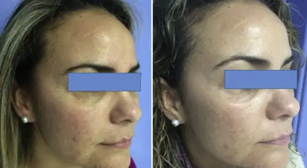 Comparación antes y después de un peeling para manchas. La piel luce más uniforme y luminosa tras el tratamiento.