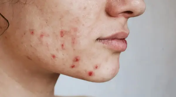 Primer plano de una mejilla con acné inflamado, mostrando la búsqueda de cómo quitar el acné.