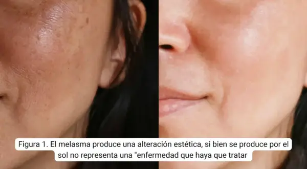 Comparación de piel con melasma y piel tratada. Descubre pastillas para quitar melasma y mejorar tu rostro.