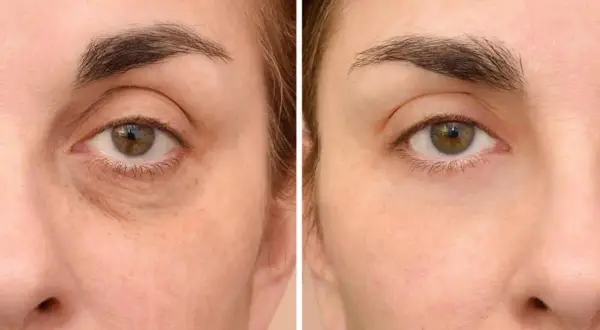Comparación de ojos: antes con ojeras oscuras y bolsas, después con piel más lisa y luminosa.