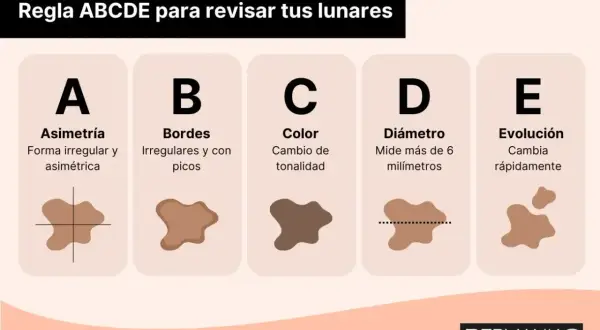 Regla ABCDE para revisar lunares: Asimetría, Bordes irregulares, Color cambiante, Diámetro mayor a 6mm, Evolución rápida. Una mancha negra en la piel puede ser señal de alerta.