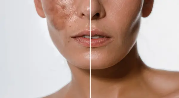 Comparación de piel antes y después de tratamientos despigmentantes, mostrando una reducción visible de manchas y un tono más uniforme.