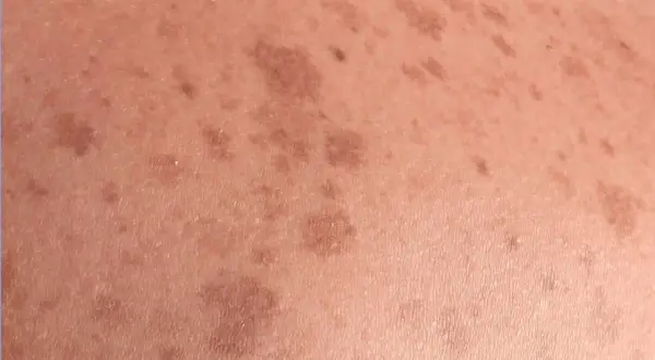 Piel con manchas marrones irregulares, indicativas de lentigo solar, resultado de la exposición al sol.