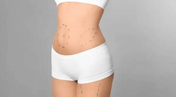 Marcas en el abdomen para tratamiento de radiofrecuencia.