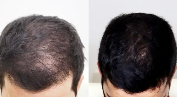 Comparativa de mesoterapia capilar antes y después: cabello más denso y oscuro.