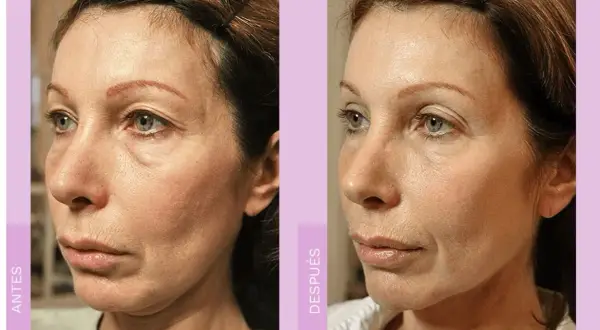 Comparativa de radiofrecuencia facial antes y después. La piel luce más firme y tersa, con menos arrugas y líneas de expresión.