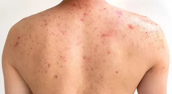Espalda con numerosos granos y marcas de acné, mostrando rojeces e inflamación.