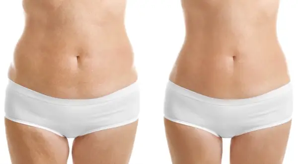 Comparativa mesoterapia corporal antes y después: abdomen más liso y tonificado.