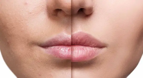 Comparación de piel antes y después, mostrando un aumento de labios y piel más lisa y uniforme.