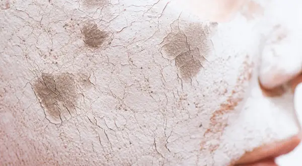Primer facial agrietado y seco, con parches oscuros, que simula una barrera cutánea dañada.