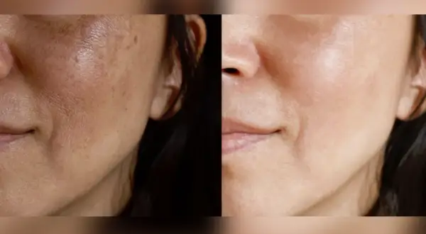 Comparación de piel: antes con melasma en la cara y después con piel más uniforme y luminosa.