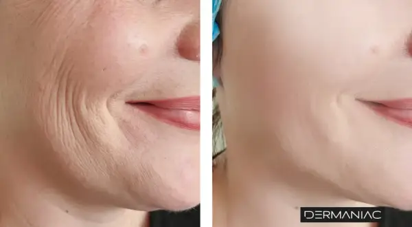 Antes y después de un tratamiento para suavizar las líneas de marioneta y rejuvenecer la piel.