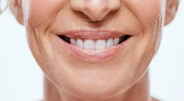 Sonrisa radiante con surco nasogeniano antes y después. Piel tersa y rejuvenecida.