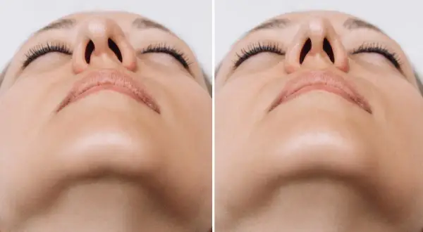 Comparativa de rinomodelación con ácido hialurónico. Mejora sutil de la forma nasal.