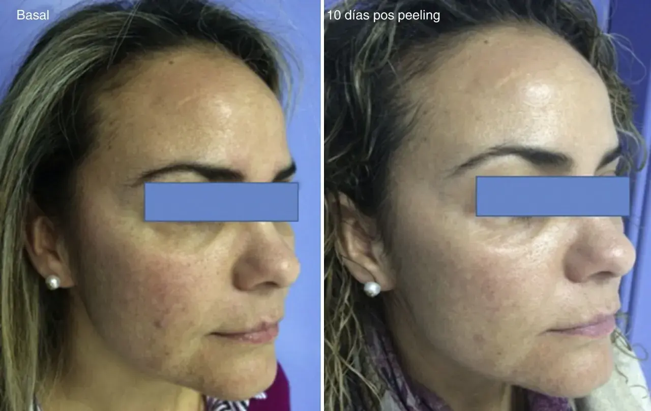 Comparación antes y después de un peeling para manchas. La piel luce más uniforme y luminosa tras el tratamiento.