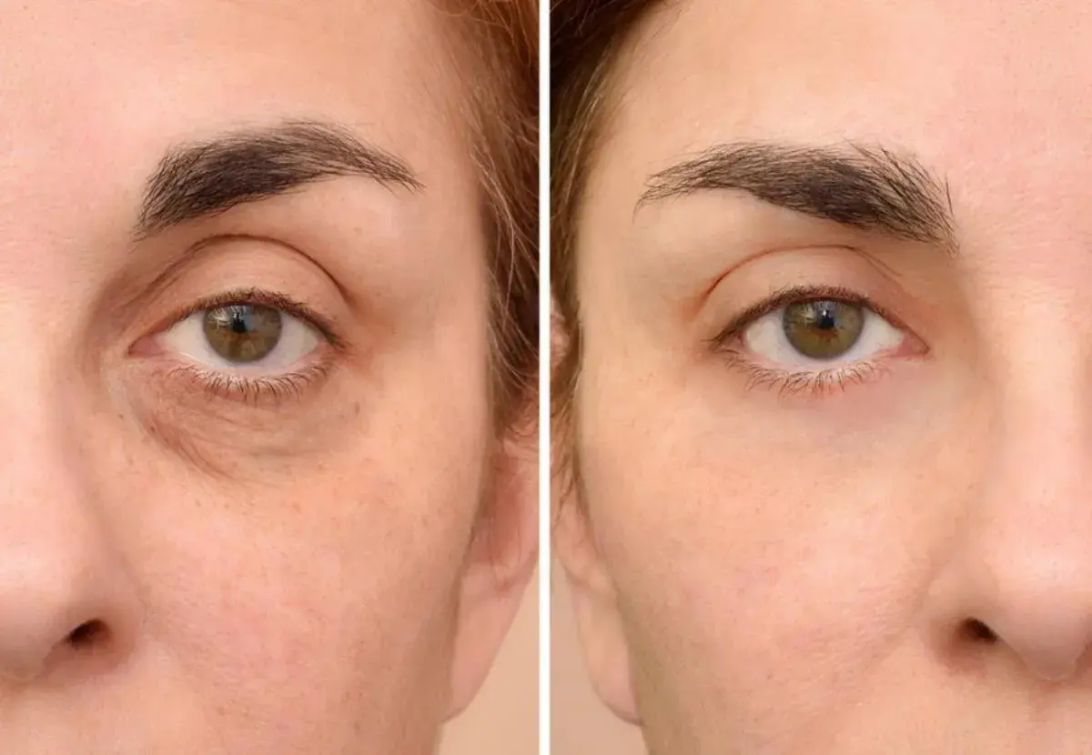 Comparación de ojos: antes con ojeras oscuras y bolsas, después con piel más lisa y luminosa.