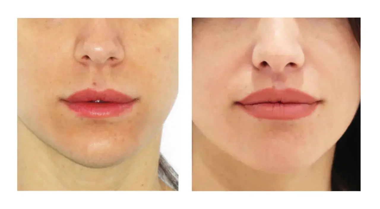 Antes y después de un lip lift: los labios se ven más definidos y voluminosos, logrando un aspecto más juvenil.