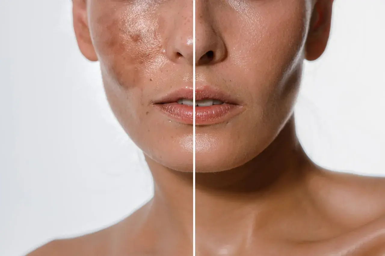 Comparación de piel antes y después de tratamientos despigmentantes, mostrando una reducción visible de manchas y un tono más uniforme.