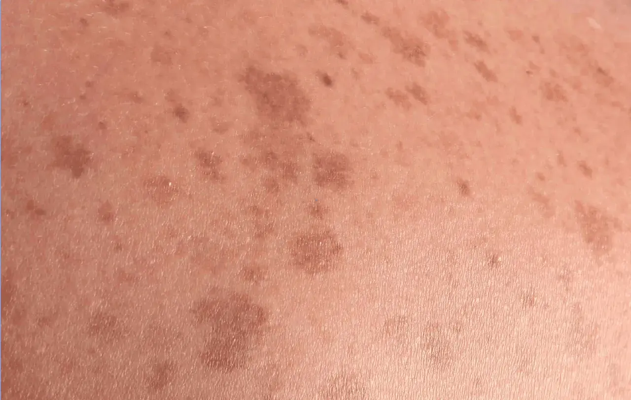 Piel con manchas marrones irregulares, indicativas de lentigo solar, resultado de la exposición al sol.