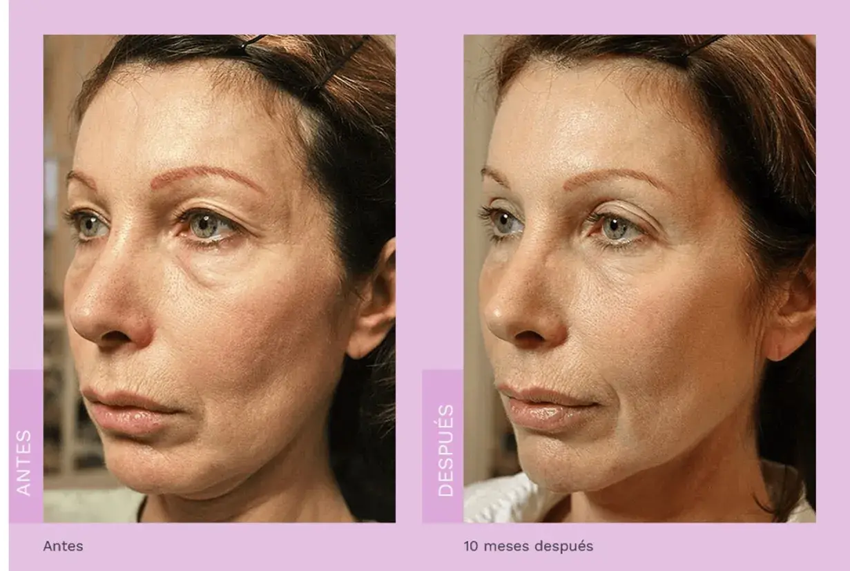 Comparativa de radiofrecuencia facial antes y después. La piel luce más firme y tersa, con menos arrugas y líneas de expresión.