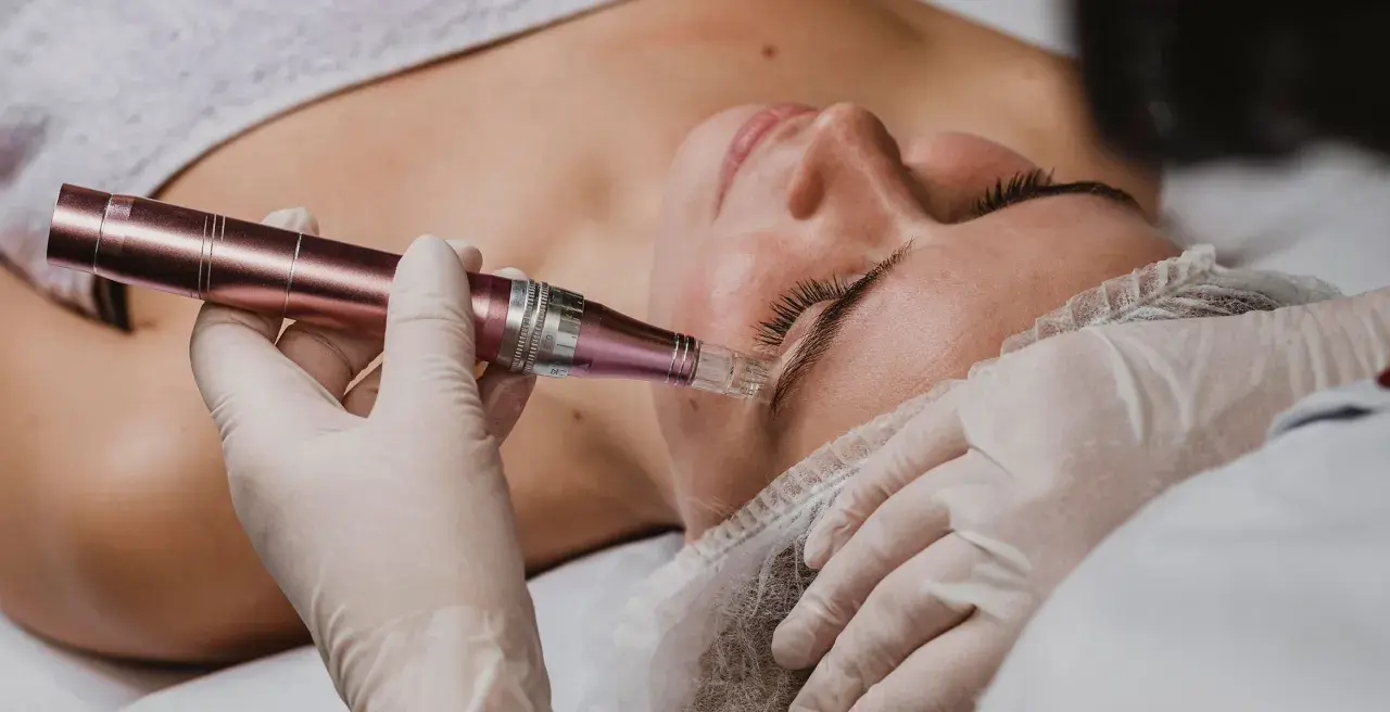 Un profesional realiza un microneedling facial con un dispositivo de microagujas para mejorar la piel.