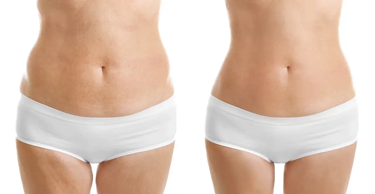 Comparativa mesoterapia corporal antes y después: abdomen más liso y tonificado.