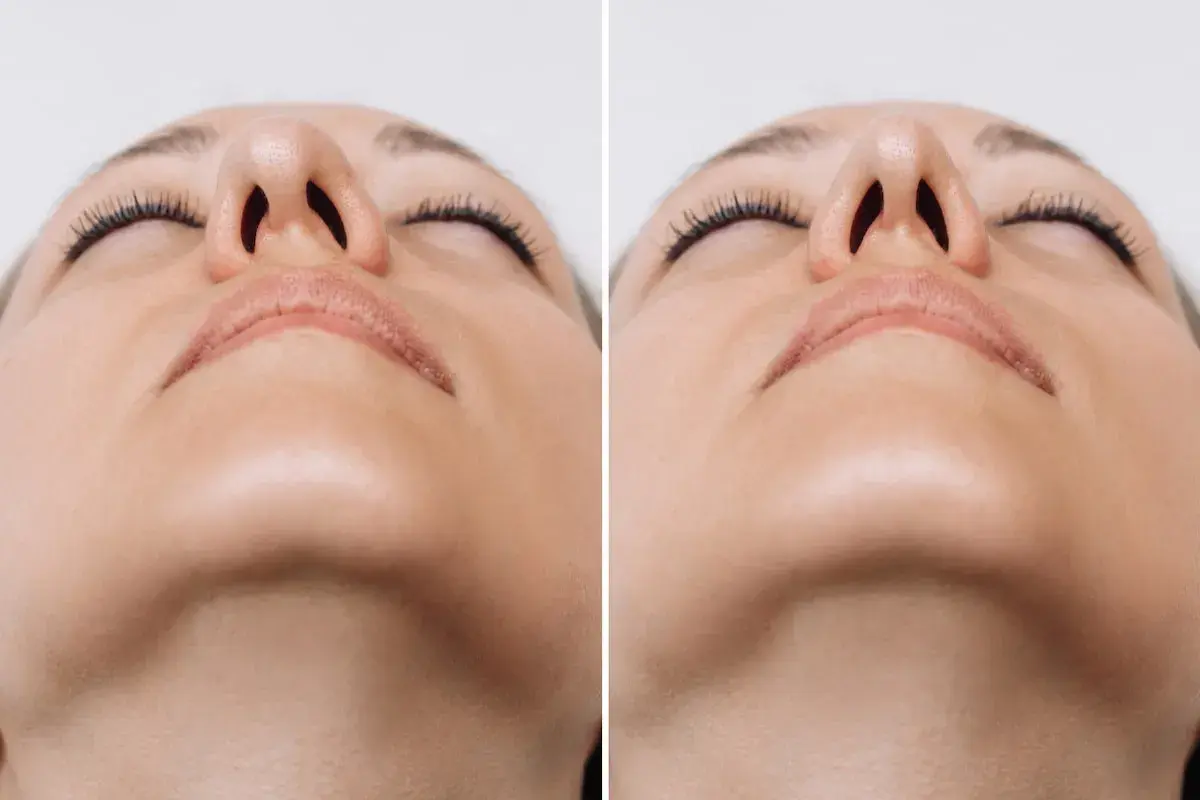 Comparativa de rinomodelación con ácido hialurónico. Mejora sutil de la forma nasal.