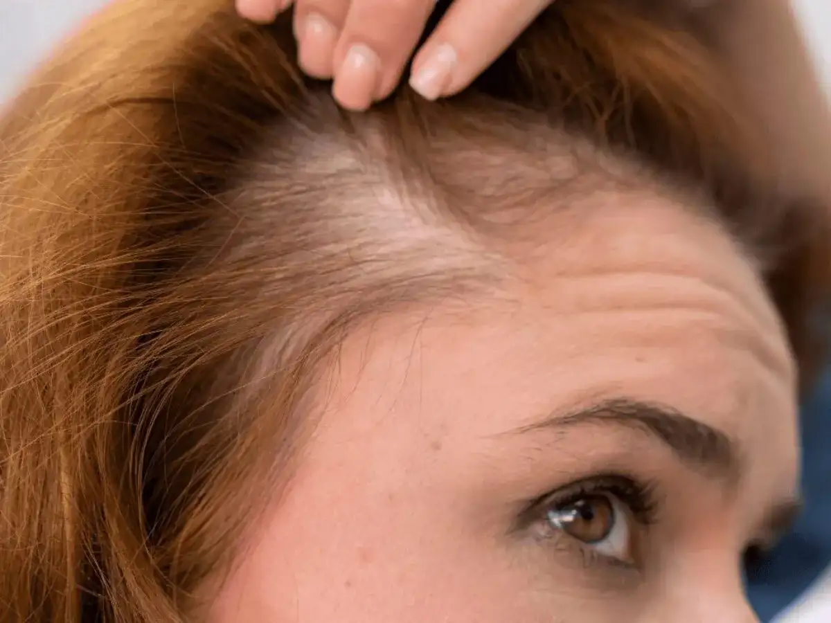 Primer plano de una mujer examinando su cuero cabelludo, preocupada por la caida de pelo.