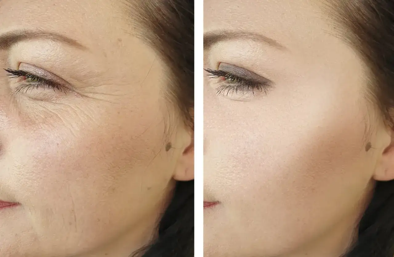 Comparación antes y después de radiofrecuencia facial. La piel luce más lisa y rejuvenecida, con menos arrugas visibles.