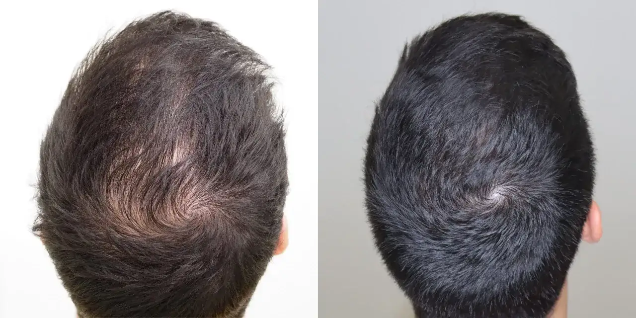 Comparativa de mesoterapia capilar antes y después: cabello más denso y saludable.